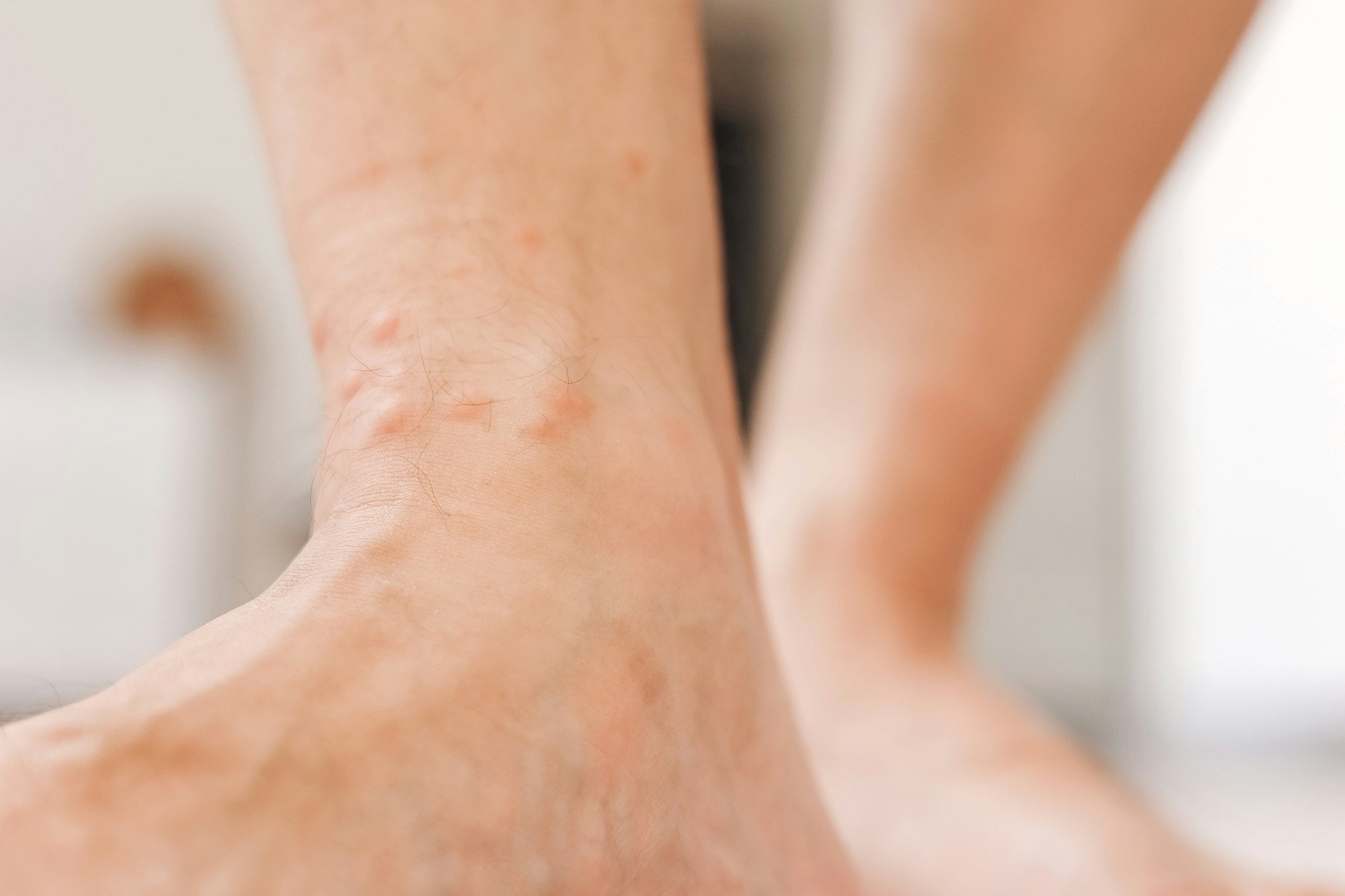 Close up allergic rash dermatitis eczema on man foot. Leg with red rash caused by insect bites.